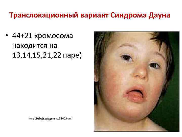 Транслокационный вариант Синдрома Дауна • 44+21 хромосома находится на 13, 14, 15, 21, 22
