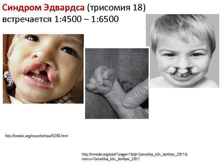 Синдром Эдвардса (трисомия 18) встречается 1: 4500 – 1: 6500 http: //bratsk. org/report/show/8280. html