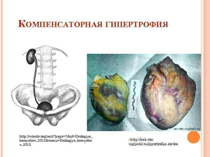 КОМПЕНСАТОРНАЯ ГИПЕРТРОФИЯ http: //vmede. org/sait/? page=7&id=Urologiya_ komyakov_2012&menu=Urologiya_komyako v_2012 http: //kak-eto- vygljadit. ru/gipertrofija-serdca 