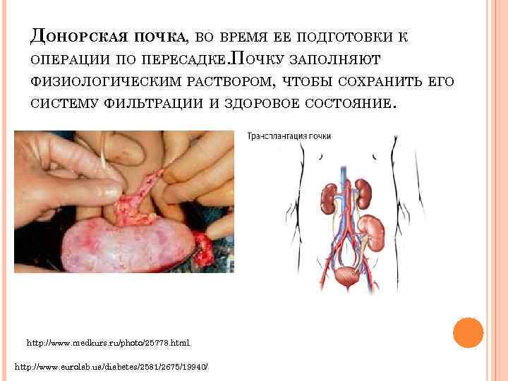 ДОНОРСКАЯ ПОЧКА, ВО ВРЕМЯ ЕЕ ПОДГОТОВКИ К ОПЕРАЦИИ ПО ПЕРЕСАДКЕ. ПОЧКУ ЗАПОЛНЯЮТ ФИЗИОЛОГИЧЕСКИМ РАСТВОРОМ,