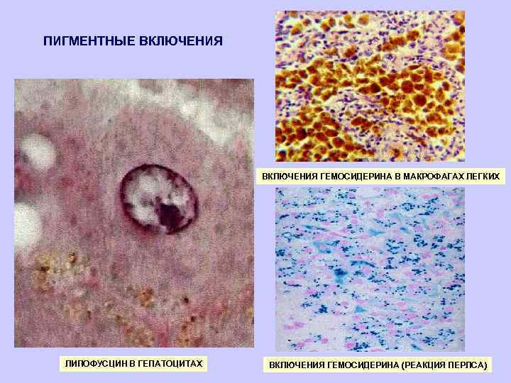ПИГМЕНТНЫЕ ВКЛЮЧЕНИЯ ГЕМОСИДЕРИНА В МАКРОФАГАХ ЛЕГКИХ ЛИПОФУСЦИН В ГЕПАТОЦИТАХ ВКЛЮЧЕНИЯ ГЕМОСИДЕРИНА (РЕАКЦИЯ ПЕРЛСА) 