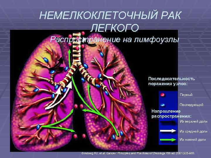 НЕМЕЛКОКЛЕТОЧНЫЙ РАК ЛЕГКОГО Распространение на лимфоузлы Последовательность поражения узлов: Первый Последующий Направление распространения: Из