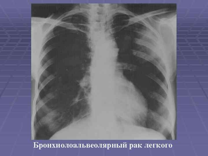 Бронхиолоальвеолярный рак легкого 