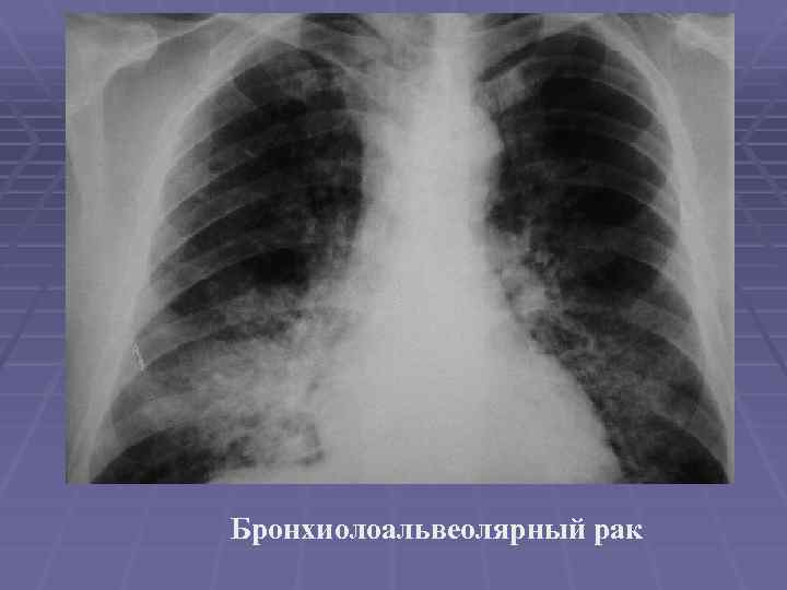 Бронхиолоальвеолярный рак 