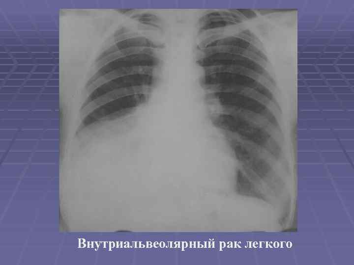 Внутриальвеолярный рак легкого 
