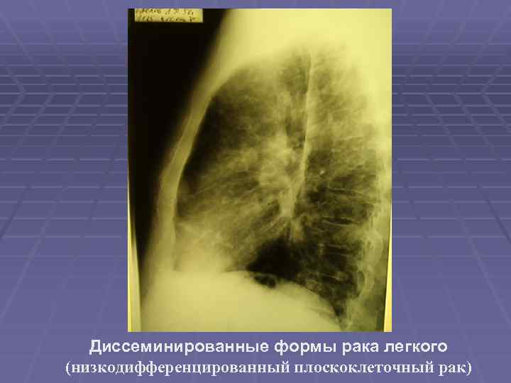 Диссеминированные формы рака легкого (низкодифференцированный плоскоклеточный рак) 