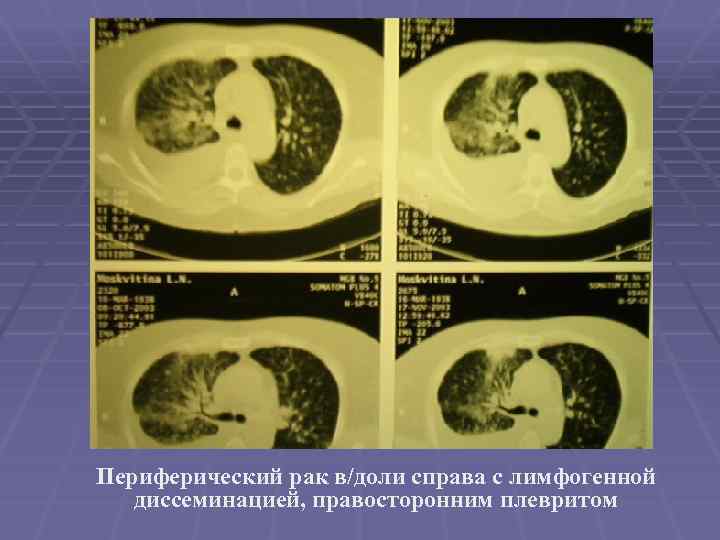 Периферический рак в/доли справа с лимфогенной диссеминацией, правосторонним плевритом 