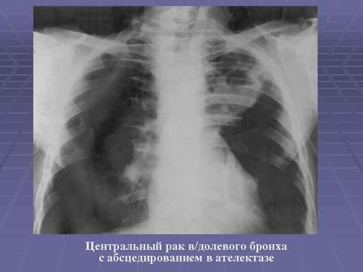 Центральный рак в/долевого бронха с абсцедированием в ателектазе 