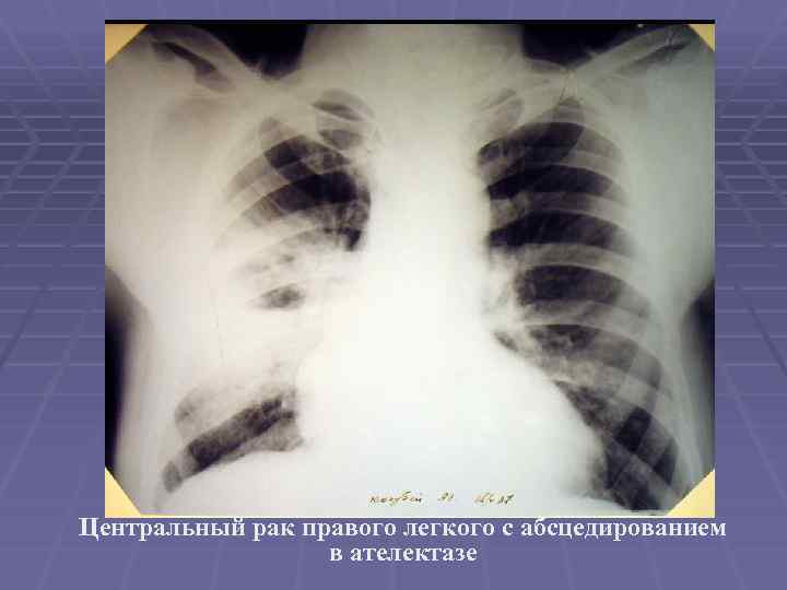 Центральный рак правого легкого с абсцедированием в ателектазе 