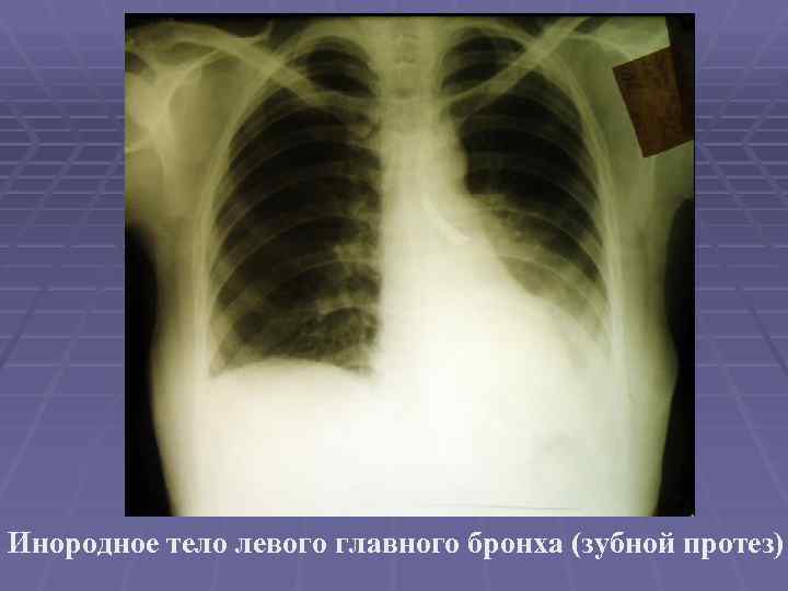 Инородное тело левого главного бронха (зубной протез) 