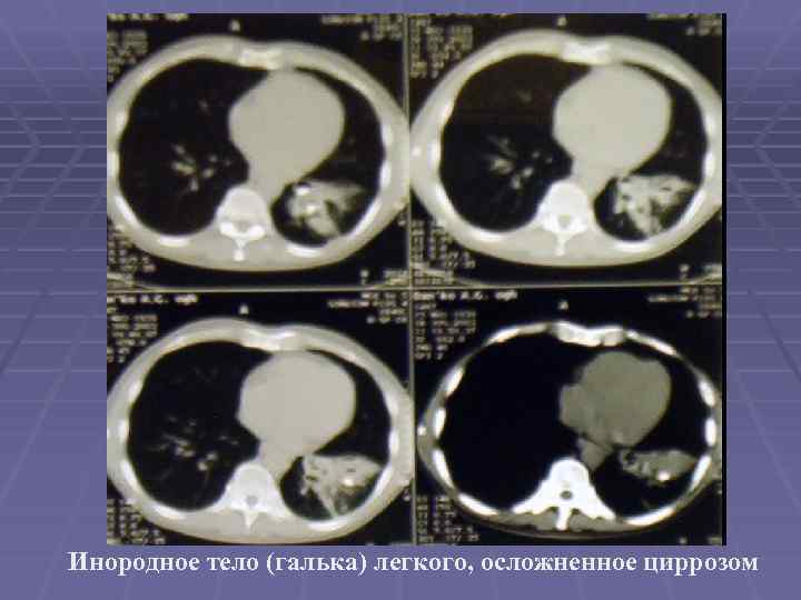 Инородное тело (галька) легкого, осложненное циррозом 