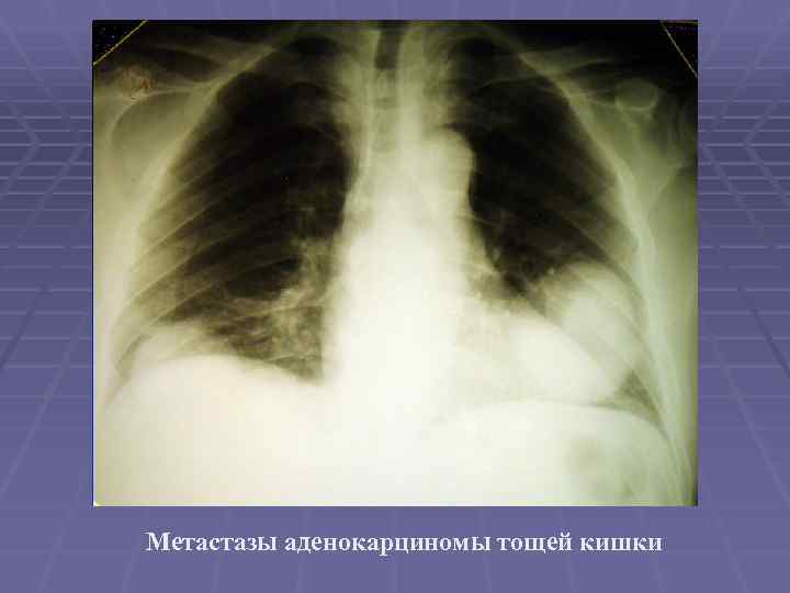 Метастазы аденокарциномы тощей кишки 