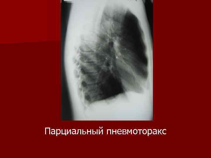 Парциальный пневмоторакс 