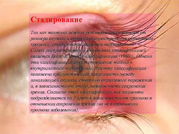 Стадирование Так как тактика лечения ретинобластом зависит от размера опухоли и степени распространения опухолевого