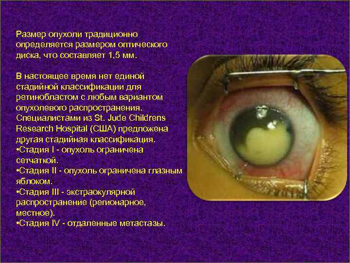 Размер опухоли традиционно определяется размером оптического диска, что составляет 1, 5 мм. В настоящее