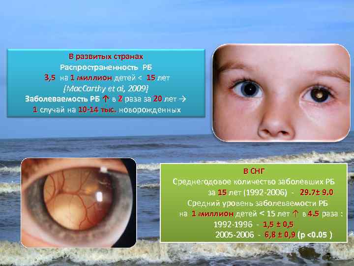 В развитых странах Распространенность РБ 3, 5 на 1 миллион детей < 15 лет