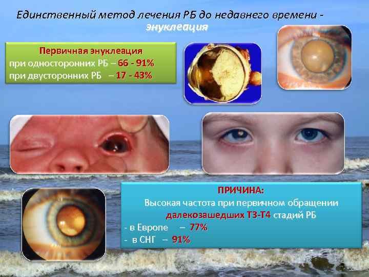 Единственный метод лечения РБ до недавнего времени энуклеация Первичная энуклеация при односторонних РБ –