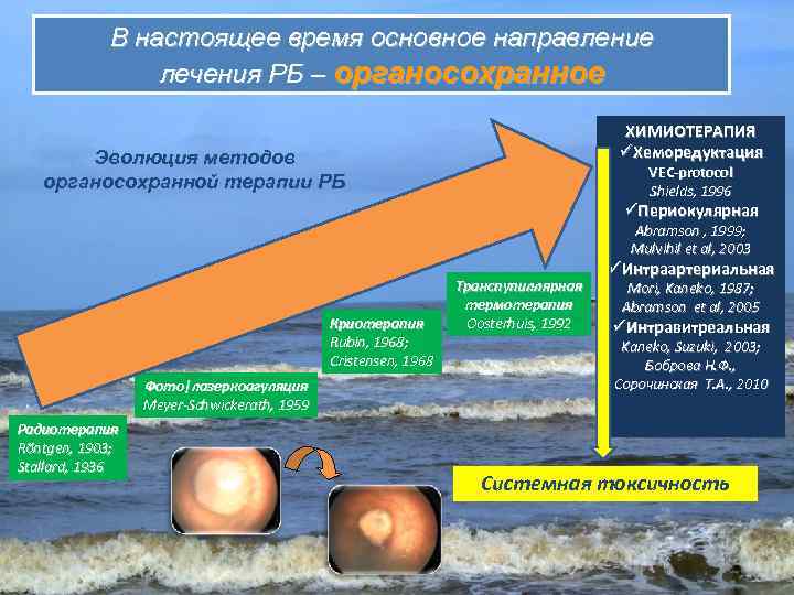 В настоящее время основное направление лечения РБ – органосохранное ХИМИОТЕРАПИЯ üХеморедуктация Эволюция методов органосохранной