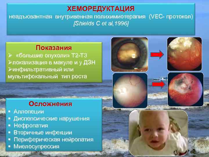 ХЕМОРЕДУКТАЦИЯ неадъювантная внутривенная полихимиотерапия (VEC- протокол) [Shields C et al, 1996] Показания Ø «большие