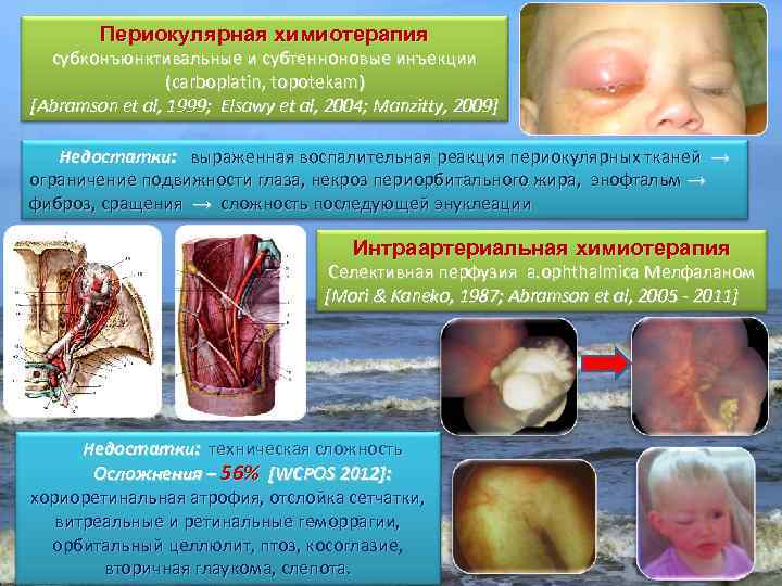 Периокулярная химиотерапия субконъюнктивальные и субтенноновые инъекции (carboplatin, topotekam) [Abramson et al, 1999; Elsawy et