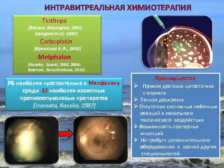 ИНТРАВИТРЕАЛЬНАЯ ХИМИОТЕРАПИЯ Tiothepa [Ericson, Rosengren, 1961; Seregard et al, 1995] Carboplatin [Бровкина А. Ф.