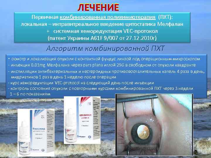 ЛЕЧЕНИЕ Первичная комбинированная полихимиотерапия (ПХТ): локальная – интравитреальное введение цитостатика Мелфалан + системная хеморедуктация