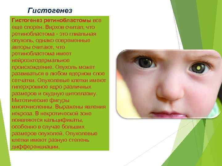 Гистогенез ретинобластомы все еще спорен. Вирхов считал, что ретинобластома - это глиальная опухоль, однако