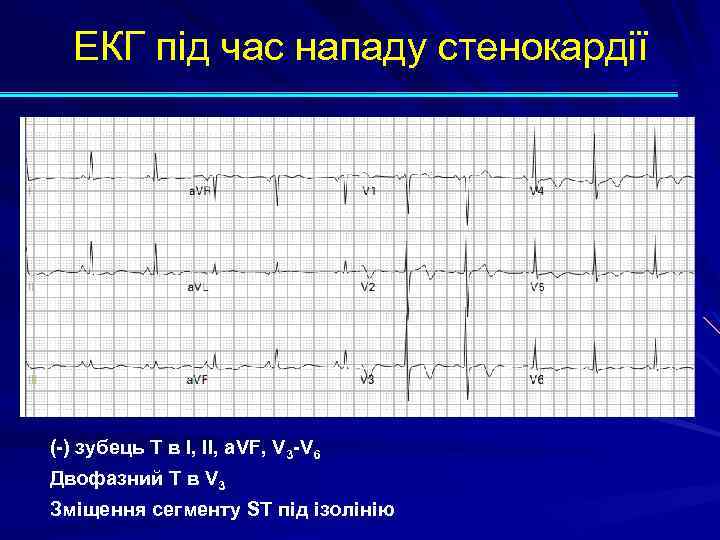 ЕКГ під час нападу стенокардії (-) зубець Т в I, II, a. VF, V