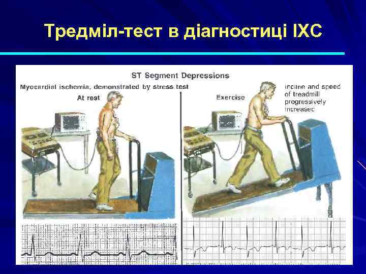 Тредміл-тест в діагностиці ІХС 