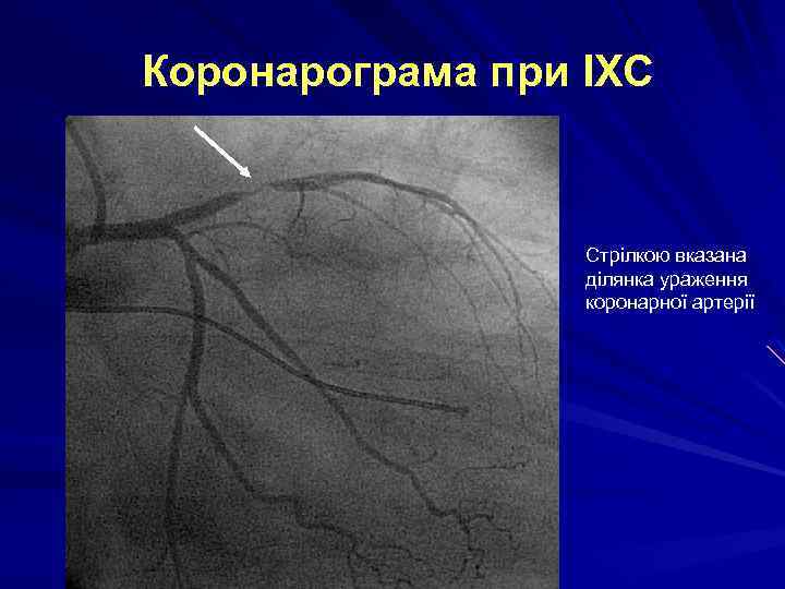 Коронарограма при ІХС Стрілкою вказана ділянка ураження коронарної артерії 