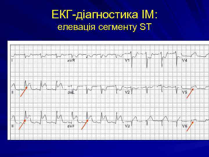 ЕКГ-діагностика ІМ: елевація сегменту SТ 