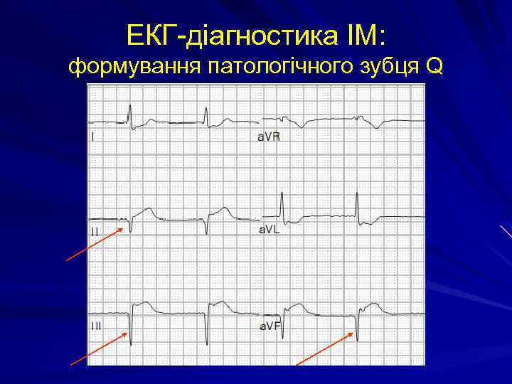 ЕКГ-діагностика ІМ: формування патологічного зубця Q 