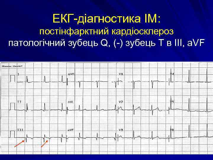 ЕКГ-діагностика ІМ: постінфарктний кардіосклероз патологічний зубець Q, (-) зубець Т в III, a. VF