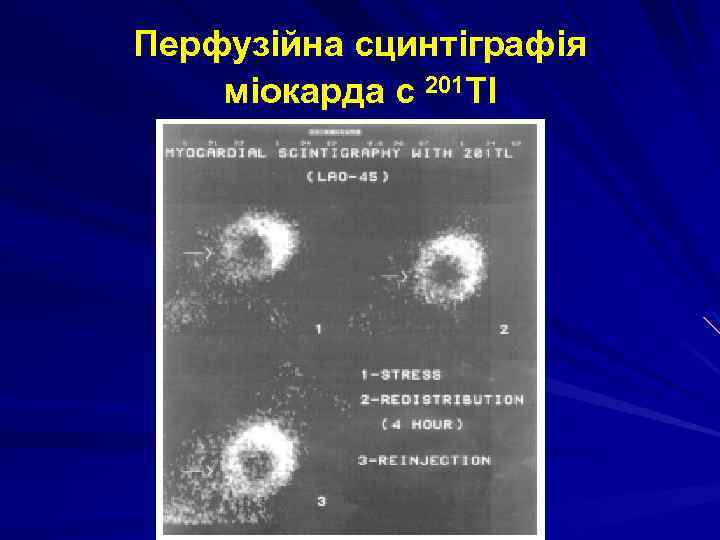 Перфузійна сцинтіграфія міокарда с 201 Tl 