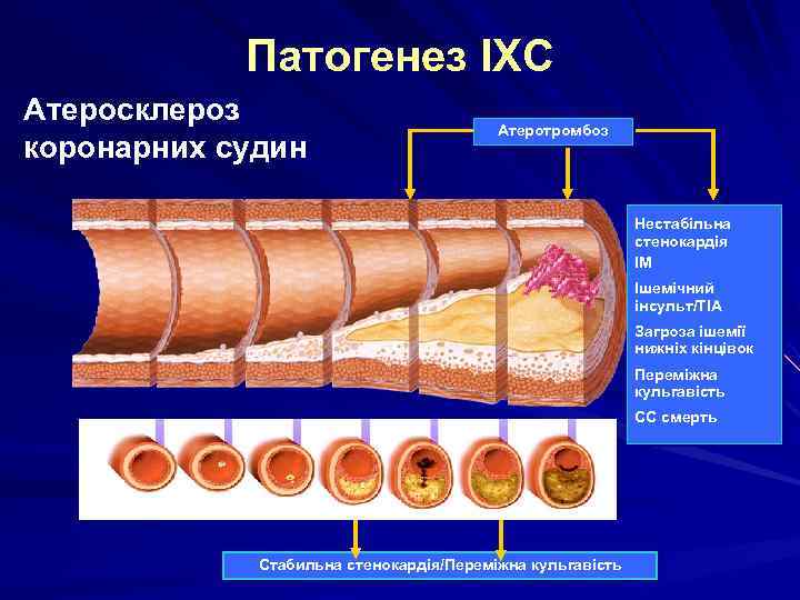 Патогенез ІХС Атеросклероз коронарних судин Атеротромбоз Нестабільна стенокардія ІМ Ішемічний інсульт/ТІА Загроза ішемії нижніх