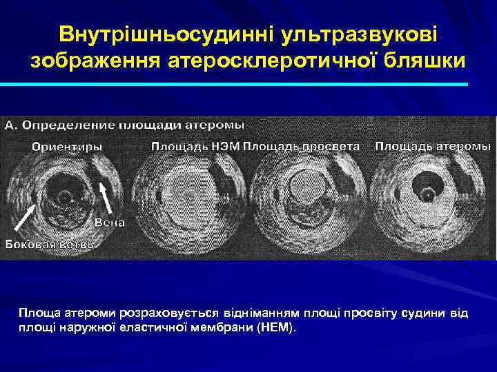 Внутрішньосудинні ультразвукові зображення атеросклеротичної бляшки Площа атероми розраховується відніманням площі просвіту судини від площі