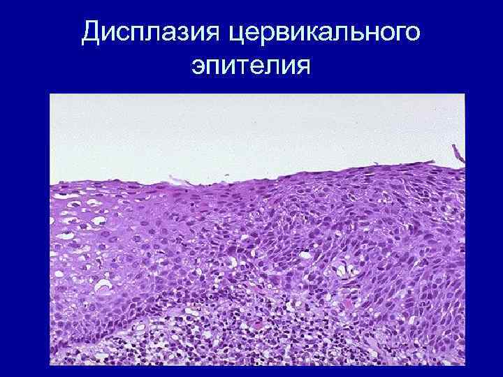 Дисплазия цервикального эпителия 