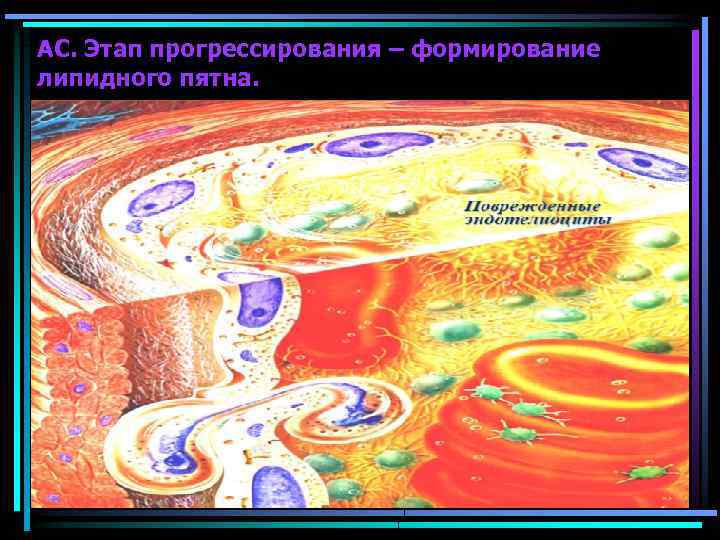 АС. Этап прогрессирования – формирование липидного пятна. 