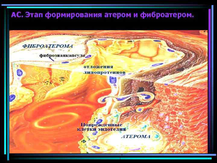 АС. Этап формирования атером и фиброатером. 