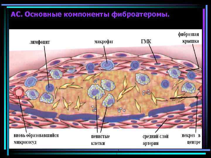 АС. Основные компоненты фиброатеромы. 