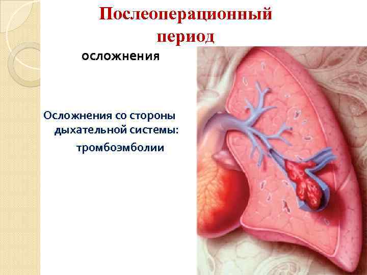 Послеоперационный период осложнения Осложнения со стороны дыхательной системы: тромбоэмболии 15 