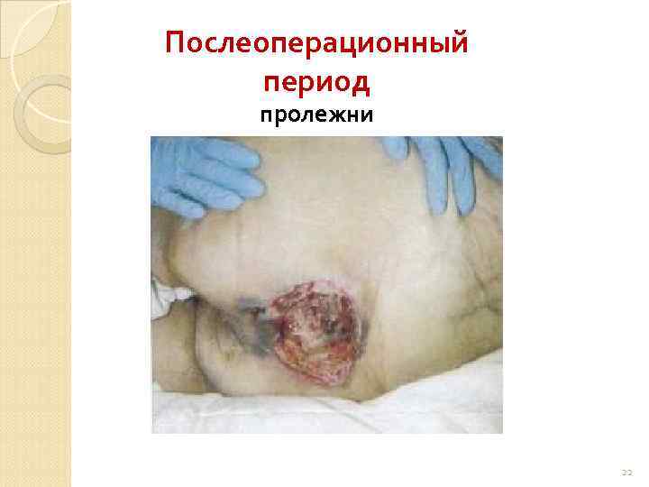 Послеоперационный период пролежни 22 