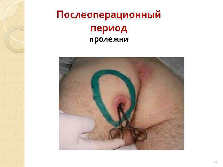 Послеоперационный период пролежни 24 