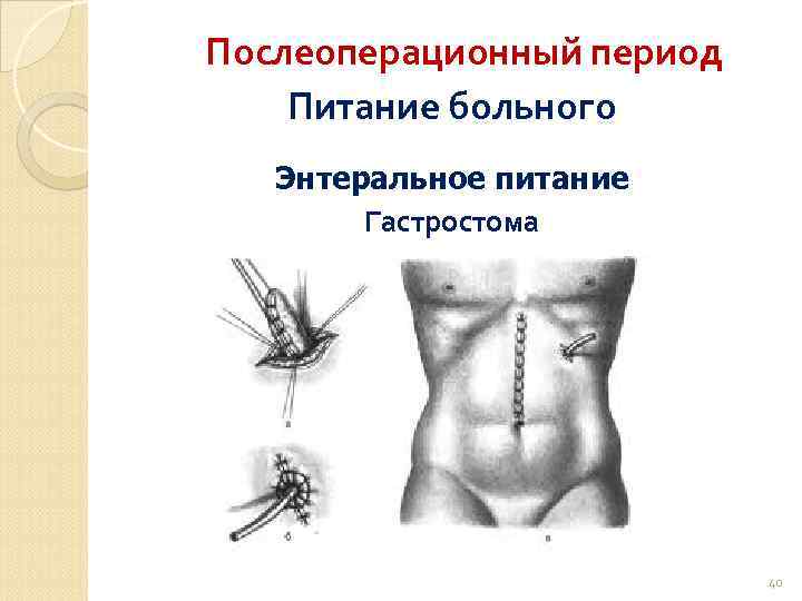Послеоперационный период Питание больного Энтеральное питание Гастростома 40 