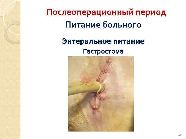 Послеоперационный период Питание больного Энтеральное питание Гастростома 41 