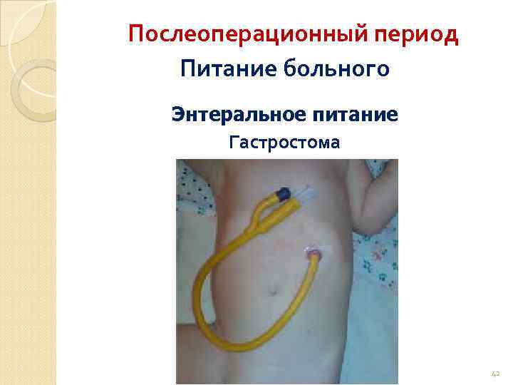 Послеоперационный период Питание больного Энтеральное питание Гастростома 42 