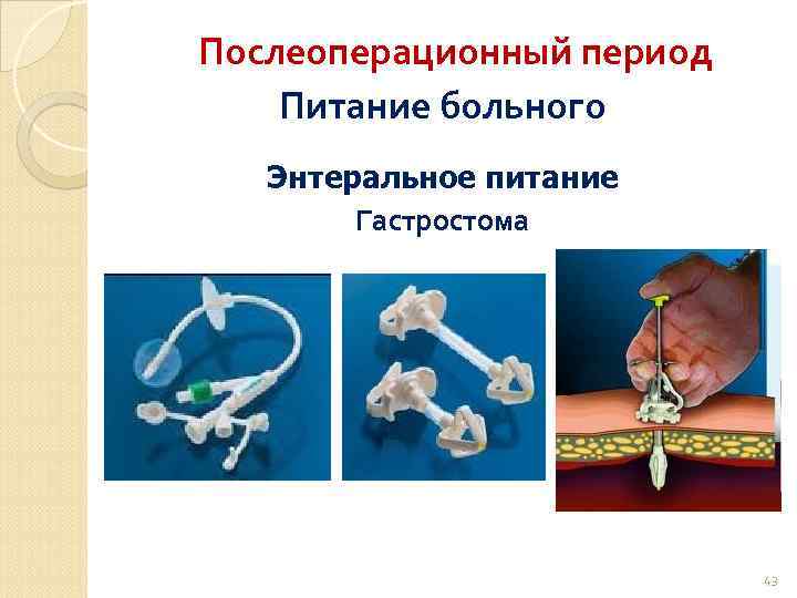 Послеоперационный период Питание больного Энтеральное питание Гастростома 43 