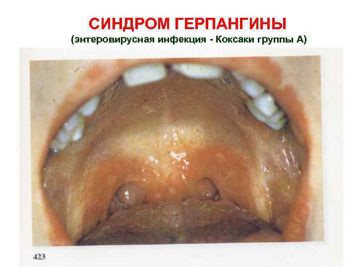 СИНДРОМ ГЕРПАНГИНЫ (энтеровирусная инфекция - Коксаки группы А) 