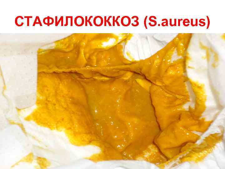 СТАФИЛОКОККОЗ (S. aureus) 