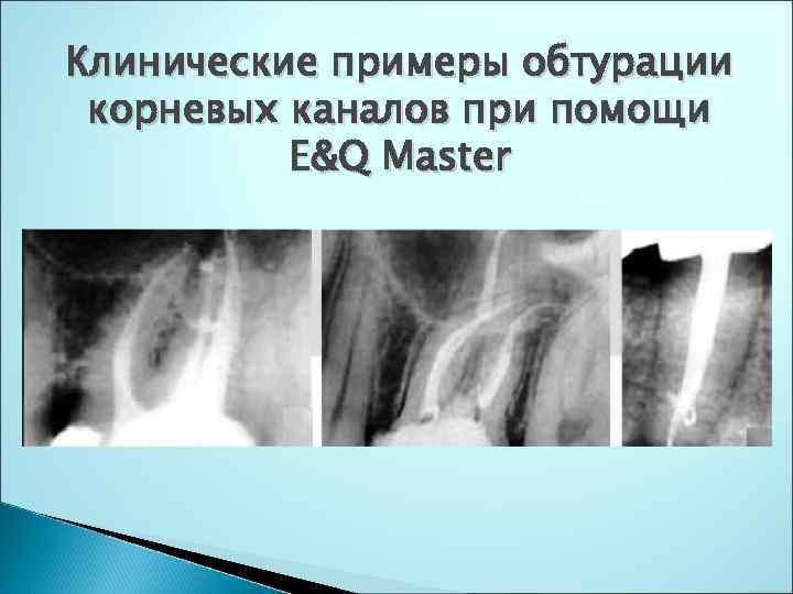Клинические примеры обтурации корневых каналов при помощи E&Q Master 